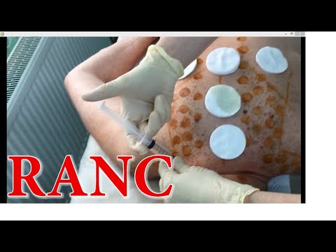 № 1107. Лечение Б Паркинсона Методом RANC. Отзывы пациентов, видео процедуры и немного теории.