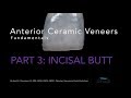 Anterior Veneers, Part 3, Incisal Butt Veneer