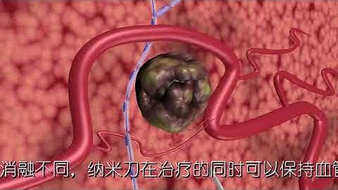 Fuda cancer hospital-Irreversible Electroporation (Nanoknife)