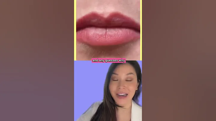 Palatal expander creates more space in a narrow upper jaw #palatalexpander