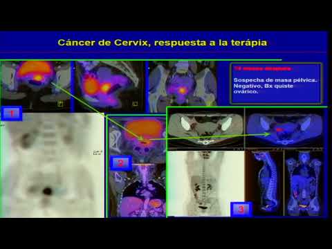 Vídeo: Resultado Después De La Radioterapia Basada En PET / TC Con PSMA En Pacientes Con Persistencia Bioquímica O Recurrencia Después De Una Prostatectomía Radical