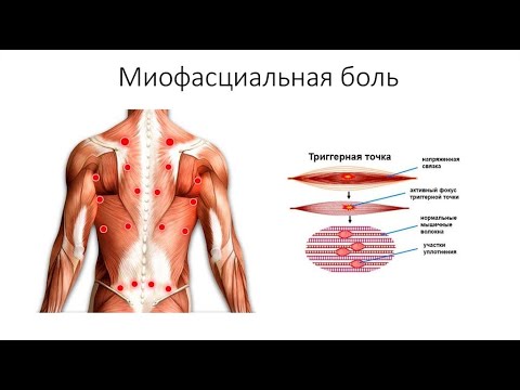 СПАЗМЫ МЫШЦ l ТИЗАНИДИН l ЛЕЧЕНИЕ l  MUSCLE SPASMS l TREATMENT l