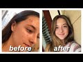 ACCUTANE FOR MILD ACNE // my story & monthly updates
