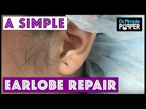 A Simple Earlobe Repair