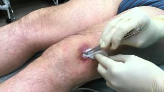 Перевязка. Видео операции - https://youtu.be/YF1TJqpzjGI Перевязка. Видео операции - https://youtu.be/YF1TJqpzjGI