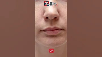 من حالات فيلر الشفاه في زين كلينيك حيث تظهر نتائج رائعة وواضحة 