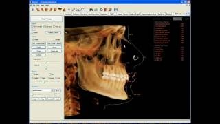 InVivo (Anatomage) 3d Cephalometric Analysis Training screenshot 5