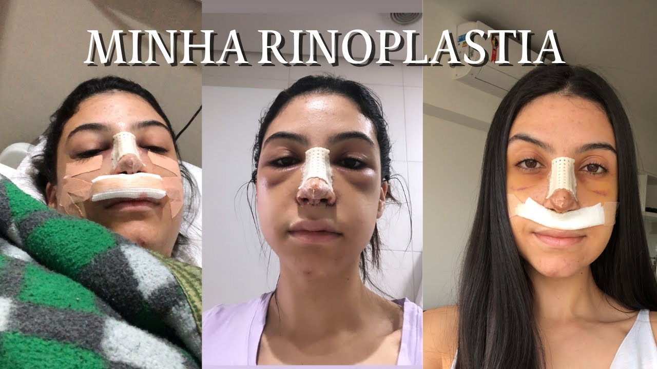 MINHA RINOPLASTIA: RELATO COM DICAS | PROBLEMA PÓS CIRURGIA | QUANTO
