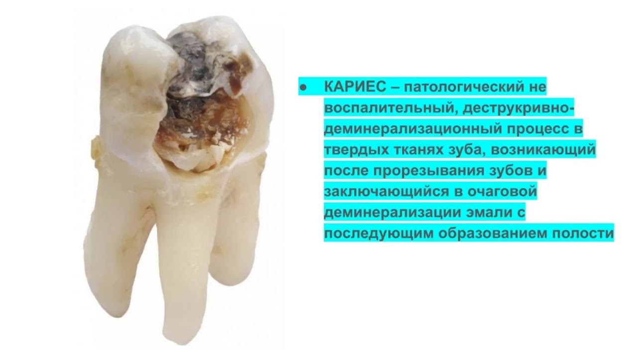 Кариес и его осложнения. Пульпит и периодонтит. - YouTube