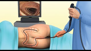 Sigmoidoscopy CPT code - simplify medical coding