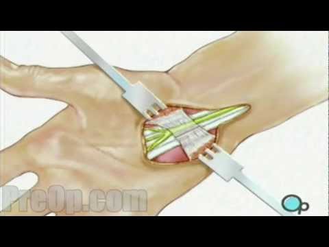 Carpal Tunnel Syndrome Repair Surgery - PreOp® Patient Education Medical HD