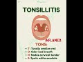 TONSILITIS - THE HAPPY SCALPEL