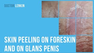 😨 Skin peeling on foreskin and on glans penis