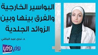 البواسير الخارجية والفرق بينها وبين الزوائد الجلدية