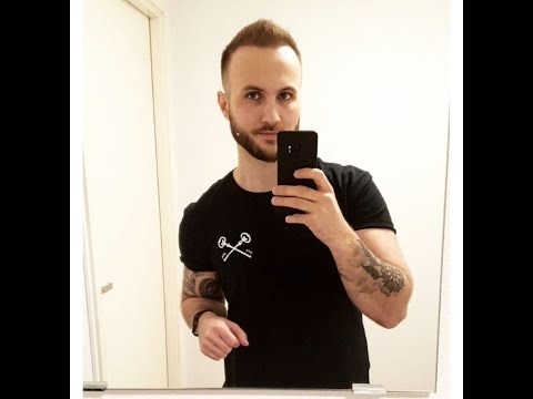 Jonas’s hair transplant