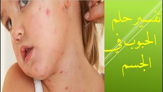 تفسير حلم الحبوب في الجسم #العزباء#المتزوجة#الحامل#الرجل عند ابن سيرين