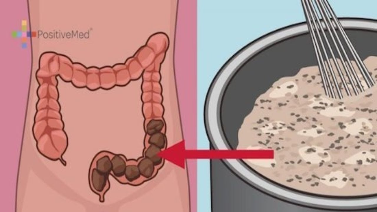 Как очистить кишечник от газов. Каловые камни в кишечнике.