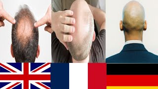 Top 5 bald countries 
