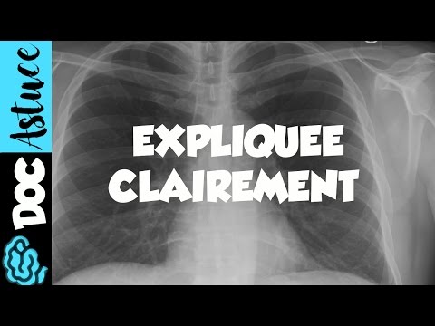 🔴 Dr Astuce - 3 ANOMALIES RADIO THORAX EXPLIQUÉES CLAIREMENT ! (PARTIE 1)