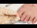 브레이스 장착만으로도 파고드는 발톱의 고통에서 벗어나자!  _Nailcollection by midae