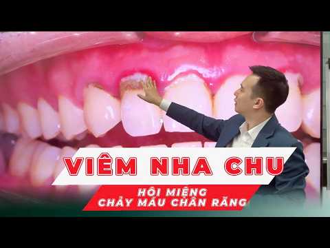 RĂNG KHÔNG SÂU NHƯNG VẪN LUNG LAY, MẤT RĂNG – VÌ SAO? | VIÊM NHA CHU| NHA KHOA GREEN