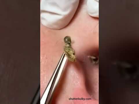 Removing 5 yr old blackhead is Scary #cystremoval #removal #dermatologist #satisfyingthings #skin