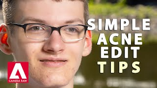 Quick Tips for Adobe Camera Raw Acne Touch-Up screenshot 4