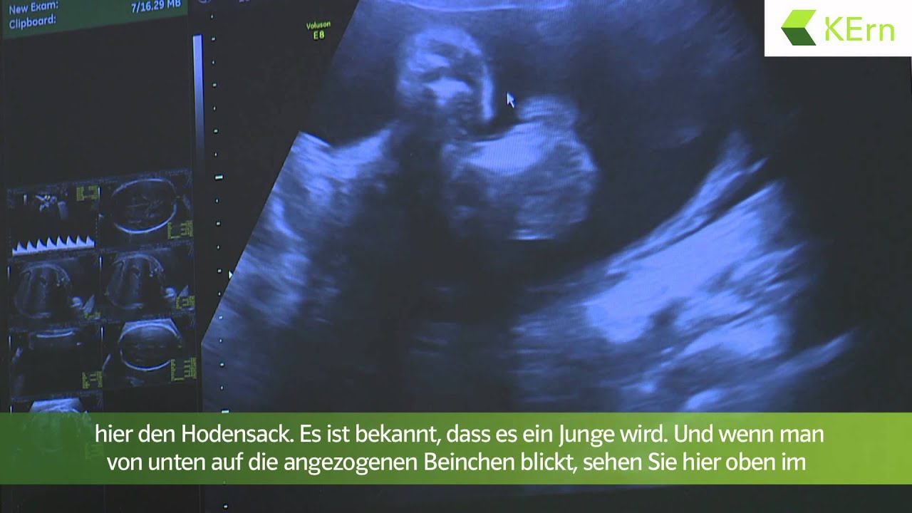 Ultraschalluntersuchung in der Schwangerschaft (inkl. 3DAufnahme) YouTube