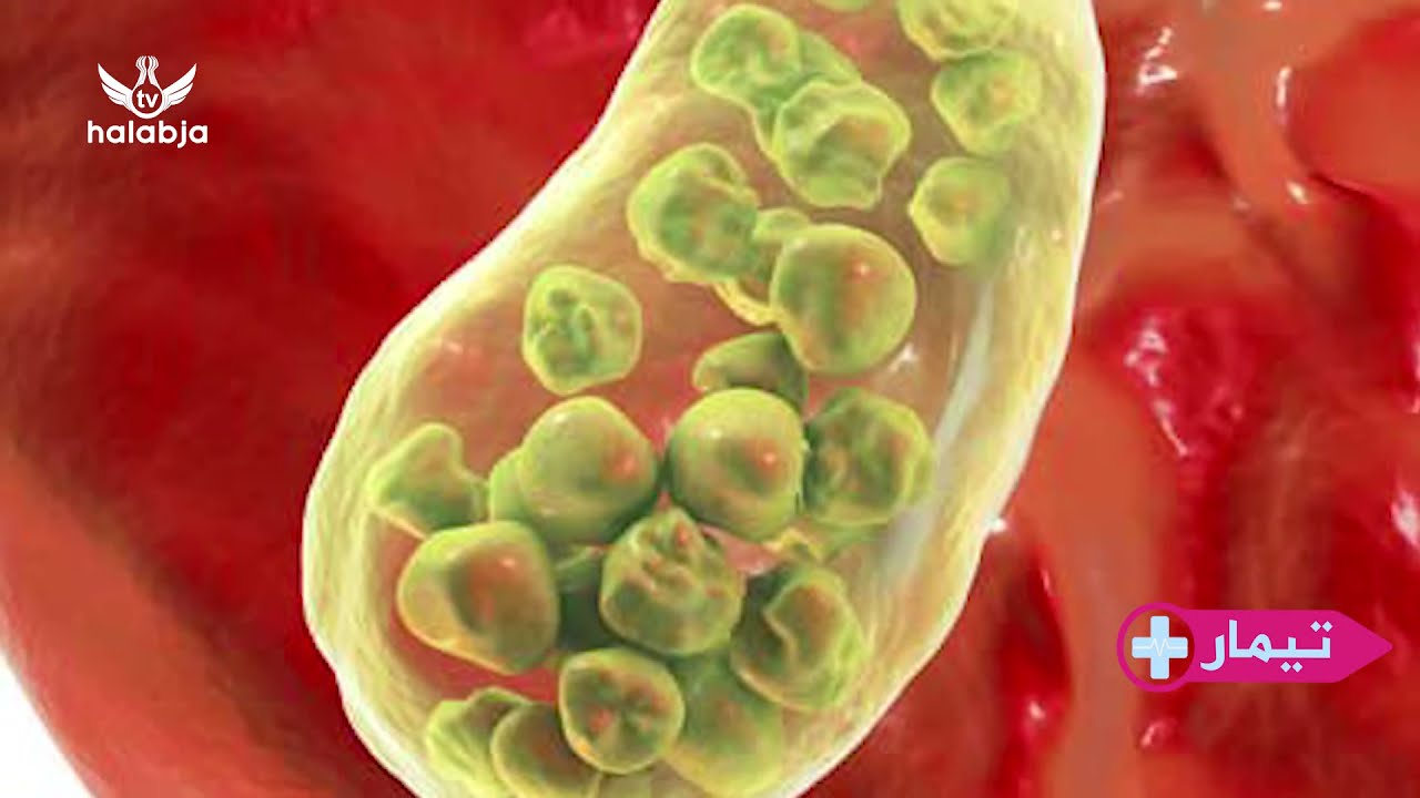 بەرنامەی تیمار - هۆکار و چارەسەری بەردی زراو