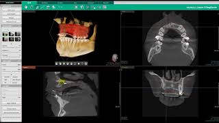 Ez3D i Implant Diagnosis Guide + Path Simulation