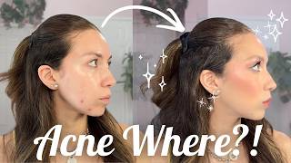 Makeup for Active Acne | How I Cover Blemishes Without Looking Cakey