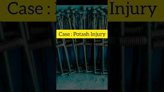 Potash Injury?|| ramji shortsfeed trending youtubeshorts doctor viral viralshort viralreels