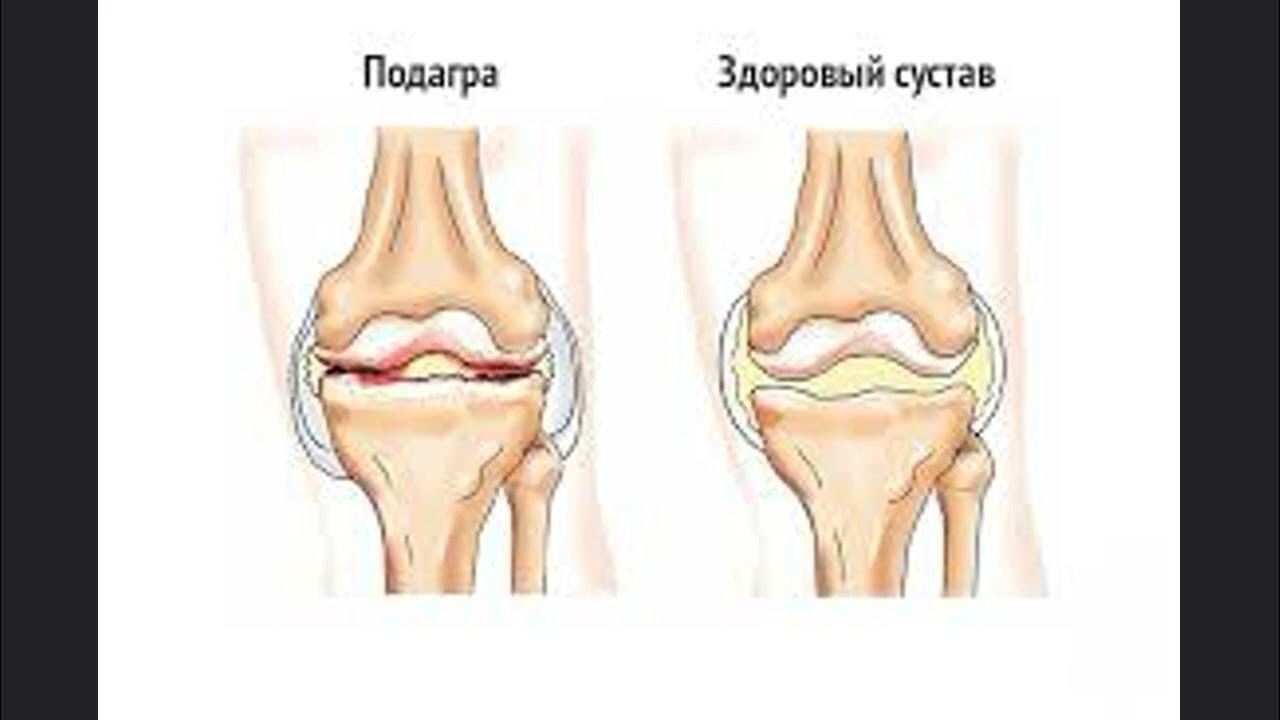 суставная подагра. подагра коленного сустава рентген. подагрический артрит плюснефалангового сустава. плюснефаланговый сустав подагра. подагра псориатический артрит.