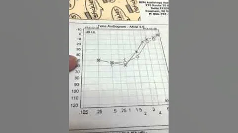 Low frequency hearing loss