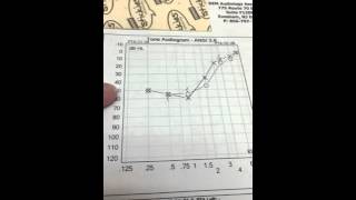 Low frequency hearing loss