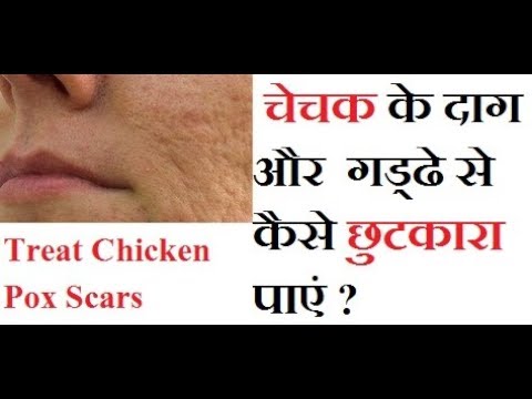 skincare routine order चेचक के जिद्दी दाग कैसे मिटायें || How to Treat Chicken Pox Scars, Marks
