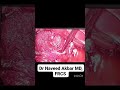 🩺 Acute Cholecystitis with Mirizzi Syndrome Type I Retrograde laproscopic cholecystectomy