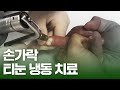 티눈 냉동치료 [Feat.피부과의사 손가락]