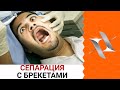 БРЕКЕТЫ: СЕПАРАЦИЯ | Главный страх пациентов