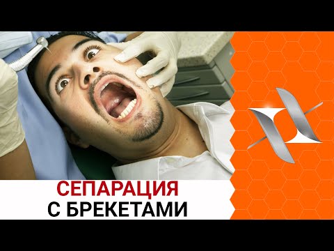 БРЕКЕТЫ: СЕПАРАЦИЯ | Главный страх пациентов