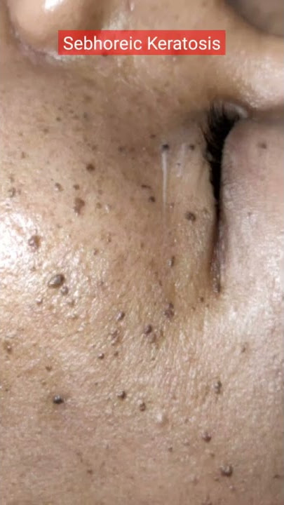 Kutil kutil kecil? Ini namanya Keratosis Sebhoreic, Laser yuk! #sebhoreickeratosis #laserco2