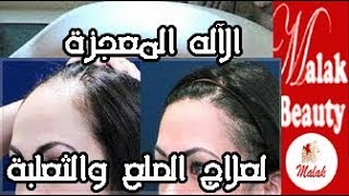 الالة المعجزة لانبات الشعر فى اسبوع/الصلع الامامى/الثعلبة/تجربة حقيقة مع خبيرة التجميل ملك