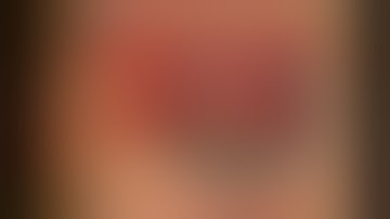 Phacolytic cataract scaffold technique