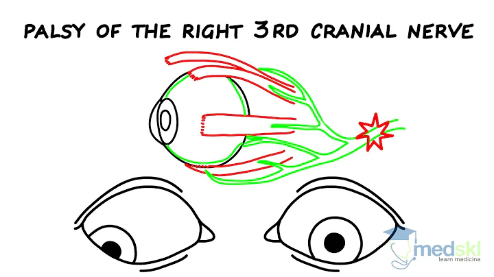 Ophthalmology  Strabismus: By Yi Ning Strube M.D.