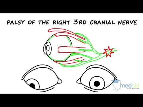 Ophthalmology – Strabismus: By Yi Ning Strube M.D.