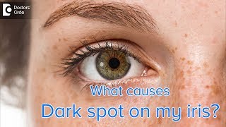 Does Ocular Melanosis affect iris? - Dr. Sriram Ramalingam