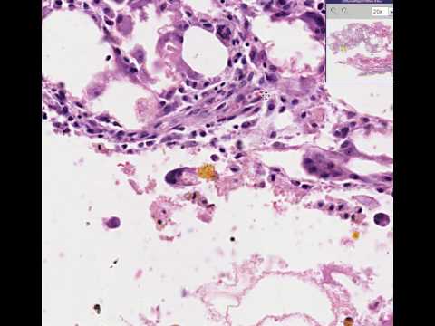 Histopathology Breast --Fat necrosis, traumatic