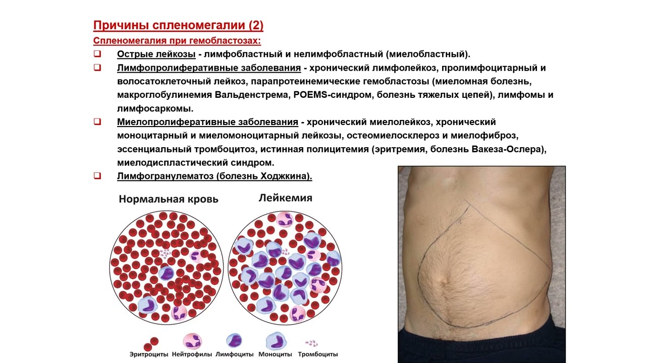 Ультразвуковая диагностика (УЗИ). Доктор Иогансен. Спленомегалия.