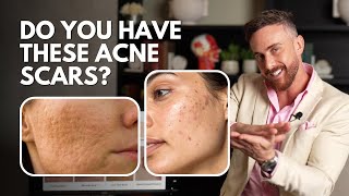 Treatment for Acne Scars – Which Options Match Which Scars?
