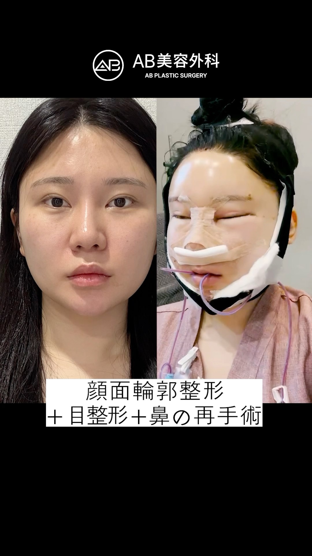 自然に可愛くなった私の整形ビフォーアフター | AB美容整形